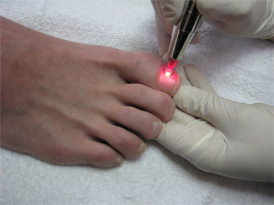 980nm nail fungus treatment laser BL-CH04